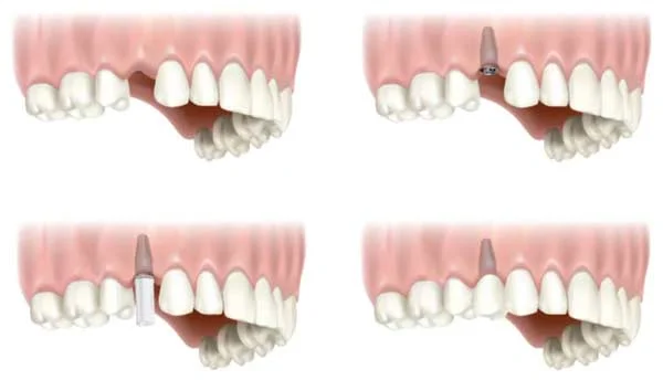 Implant dentaire avec couronne à Laval