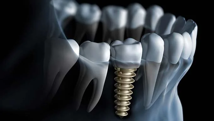 Couronnes sur implants dentaires à Laval