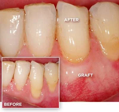 Greffe gingivale à Laval