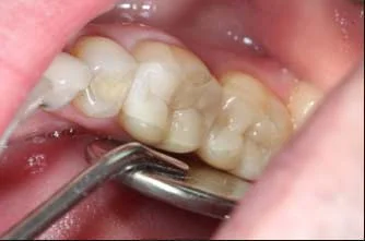 Incrustation en porcelaine
